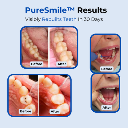 PureSmile™ Tooth Armor